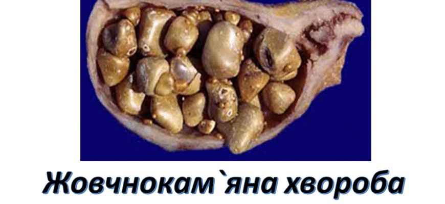 Жовчнокам’яна хвороба: причини, симптоми та методи лікування