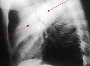 Інфільтративні зміни в легенях: причини, діагностика та лікування
