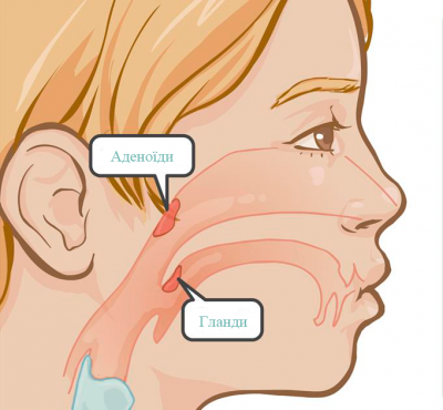 Аденоїди у дитини: симптоми, діагностика та ефективне лікування Аденоїди у дитини: симптоми, діагностика та ефективне лікування