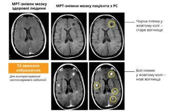 Множинні вогнищеві зміни головного мозку: причини та наслідки