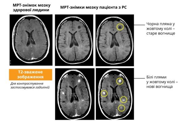 Множинні вогнищеві зміни головного мозку: причини та наслідки