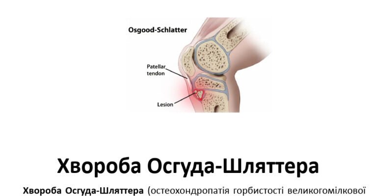 Хвороба Шляттера у дітей: причини, симптоми та лікування