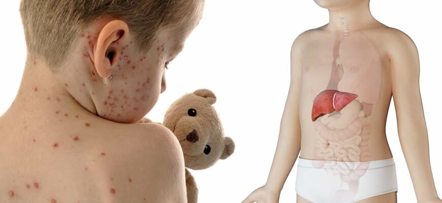 Висипка на животі у дитини: причини, симптоми та лікування.