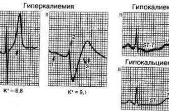Реципрокні зміни на ЕКГ: що це означає для вашого здоров’я