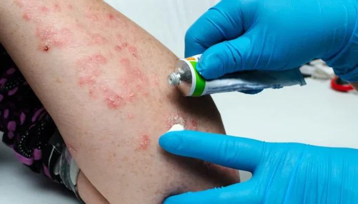 Грибкові інфекції: причини, симптоми та ефективні методи лікування