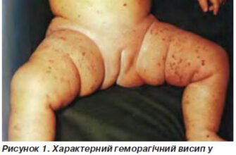 Симптоми менінгококової інфекції: ранні ознаки та діагностика