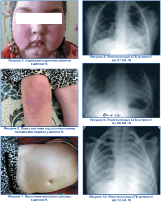 Реактивні зміни підшлункової залози у дитини: причини та лікування