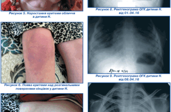 Реактивні зміни підшлункової залози у дитини: причини та лікування
