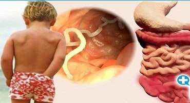 Як вивести глисти у дитини в домашніх умовах: безпечні методи Як вивести глисти у дитини в домашніх умовах: безпечні методи