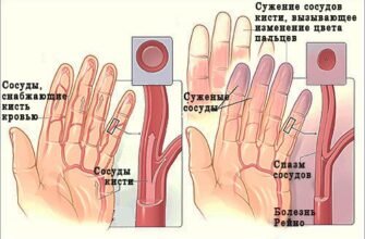 Хвороба Рейно: симптоми, причини та ефективні методи лікування