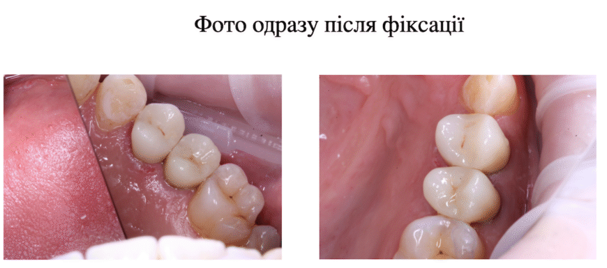 Чи можна змінити колір коронки: огляд можливостей та методів