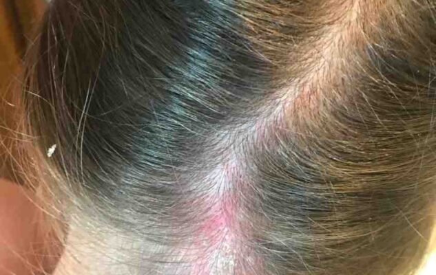 Грибок на голові у дитини: причини, симптоми та лікування