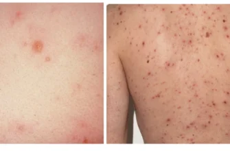 Які прищі при вітрянці: симптоми та особливості висипань