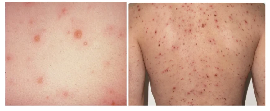 Які прищі при вітрянці: симптоми та особливості висипань