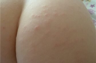 Висип на попі у дитини: фото, причини та лікування проблеми