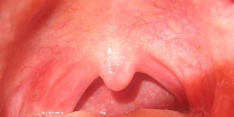 Як виглядає здорове горло у дитини: ознаки та поради для батьків Як виглядає здорове горло у дитини: ознаки та поради для батьків