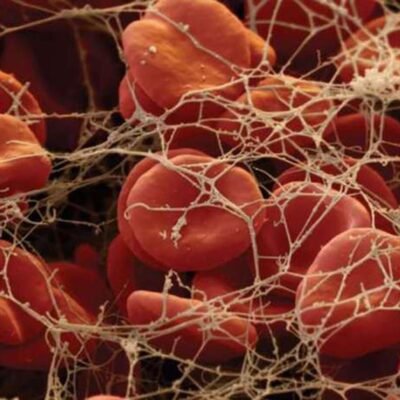 Хвороба крові: причини, симптоми та сучасні методи лікування