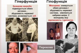 Базедова хвороба розвивається із-за порушень роботи щитовидної залози