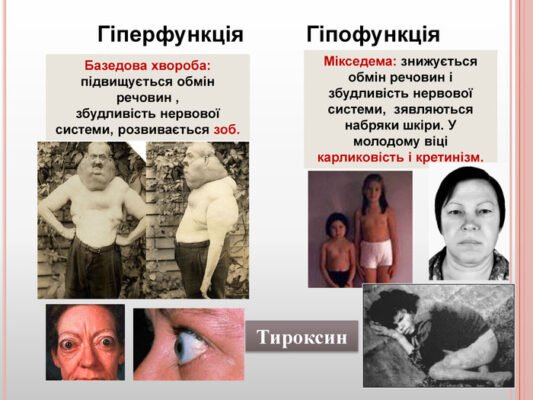 Базедова хвороба розвивається із-за порушень роботи щитовидної залози
