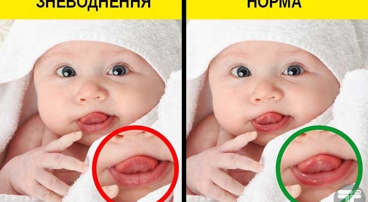 Ротавірус у дитини: симптоми, лікування та профілактика захворювання