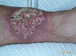 Історія хвороби Крона: від симптомів до сучасних методів лікування