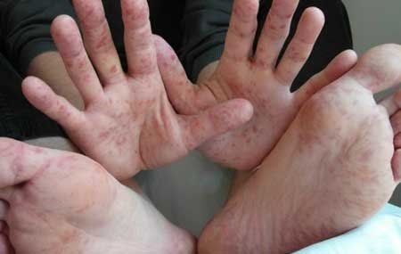 Вірусна інфекція у дитини: симптоми та діагностика захворювання