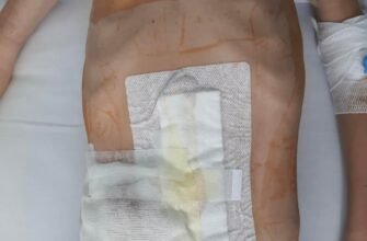 Хвороба Гіршпрунга у дітей: симптоми, діагностика та лікування