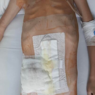 Хвороба Гіршпрунга у дітей: симптоми, діагностика та лікування