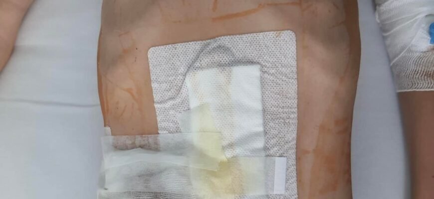 Хвороба Гіршпрунга у дітей: симптоми, діагностика та лікування