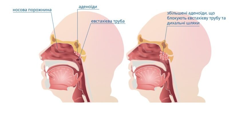 Як ефективно зменшити аденоїди у дитини: поради та методи