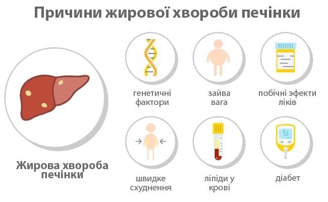 Метаболічно асоційована хвороба печінки: причини та лікування