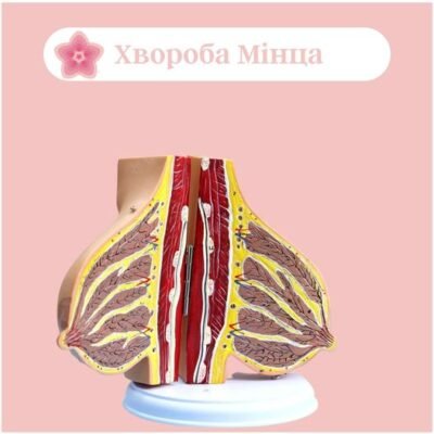 Хвороба Мінца: це симптоми, причини та методи лікування