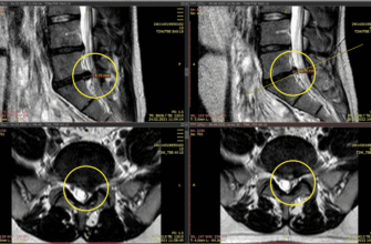 Дегенеративні зміни шийного відділу хребта: причини та профілактика