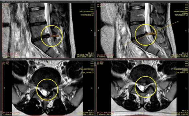 Дегенеративні зміни шийного відділу хребта: причини та профілактика