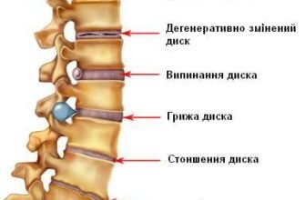 Дегенеративні зміни поперекового відділу хребта: причини та лікування