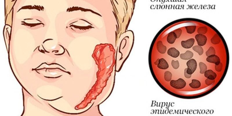 Свинка хвороба: фото симптомів і рекомендації лікування