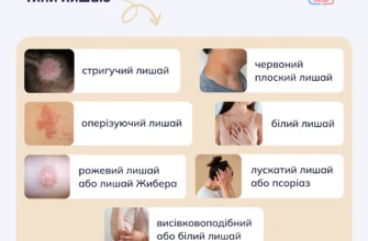Лишай у дитини: як розпізнати симптоми та ефективно лікувати