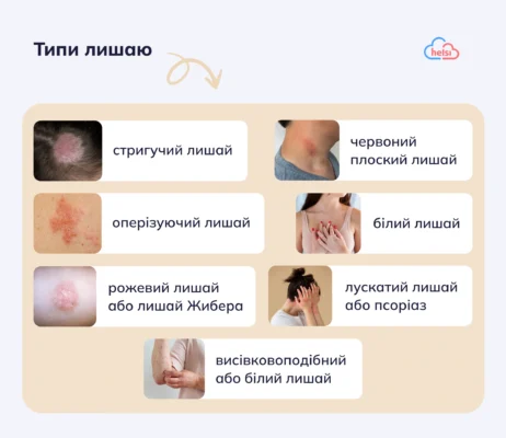 Лишай у дитини: як розпізнати симптоми та ефективно лікувати