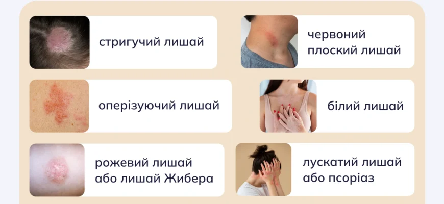Лишай у дитини: як розпізнати симптоми та ефективно лікувати Лишай у дитини: як розпізнати симптоми та ефективно лікувати