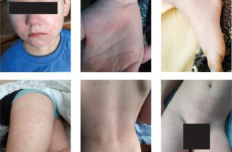 Збільшені лімфоцити у дитини: причини і що робити батькам?