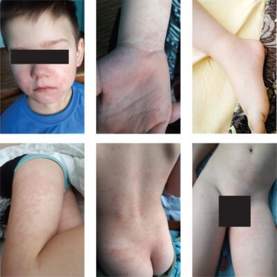 Збільшені лімфоцити у дитини: причини і що робити батькам?