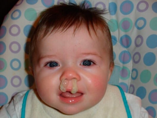 Причини та лікування густих зелених соплів у дитини