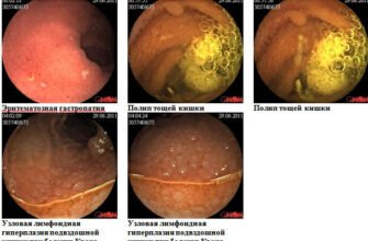 Хвороба Крона: перші симптоми, які варто знати для діагностики