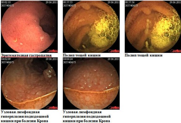 Хвороба Крона: перші симптоми, які варто знати для діагностики
