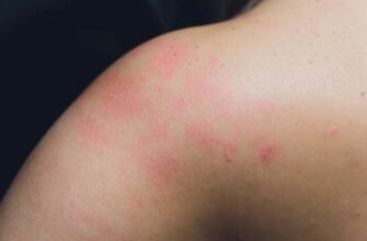 Лишай у дитини: ефективні методи лікування та поради фахівців