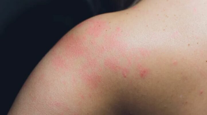 Лишай у дитини: ефективні методи лікування та поради фахівців