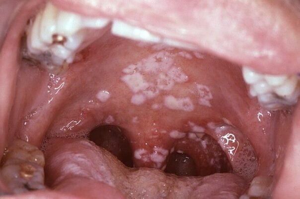 Інфекції ротової порожнини: симптоми, причини та лікування