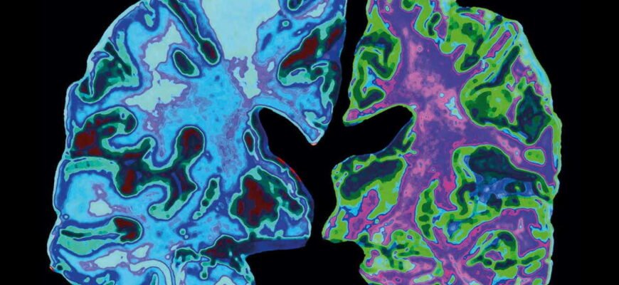 Хвороба Альцгеймера: Як розпізнати ознаки та симптоми