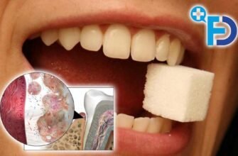 Язик при цукровому діабеті: симптоми, причини та лікування