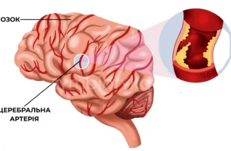 Хронічна цереброваскулярна хвороба: симптоми та лікування